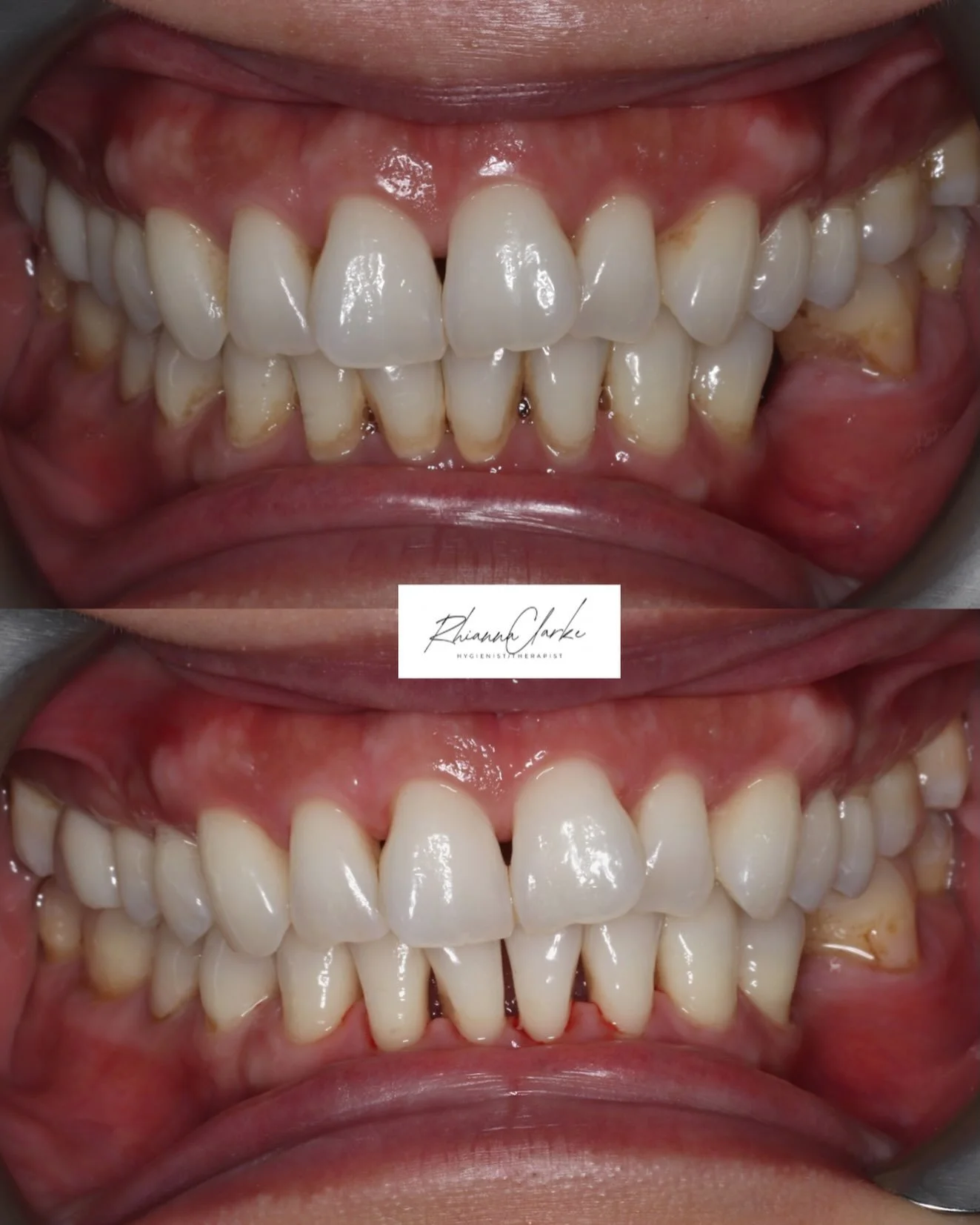 ✨Transformation Thursday ✨

Before ➡️ After

Clean teeth. Healthy gums. Stain removal.

A smile that lasts 🤍

#smilewithrhi #hygienist #therapist #stainremoval