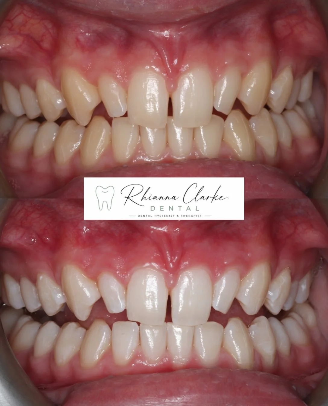 ✨Whitening Wednesdays ✨

Before ➡️ After 

This is why I love what I do &mdash; helping patients feel confident in their own smile. Instant results with in-chair tooth whitening @philipszoomteethwhitening

Genuinely loved seeing the smile on this pat