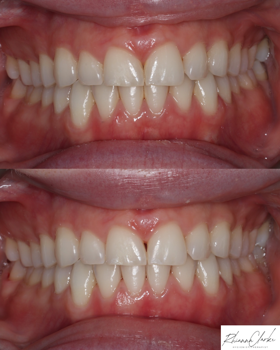Close-up of a person's teeth before and after dental cleaning, showing improved gum health and cleaner teeth.