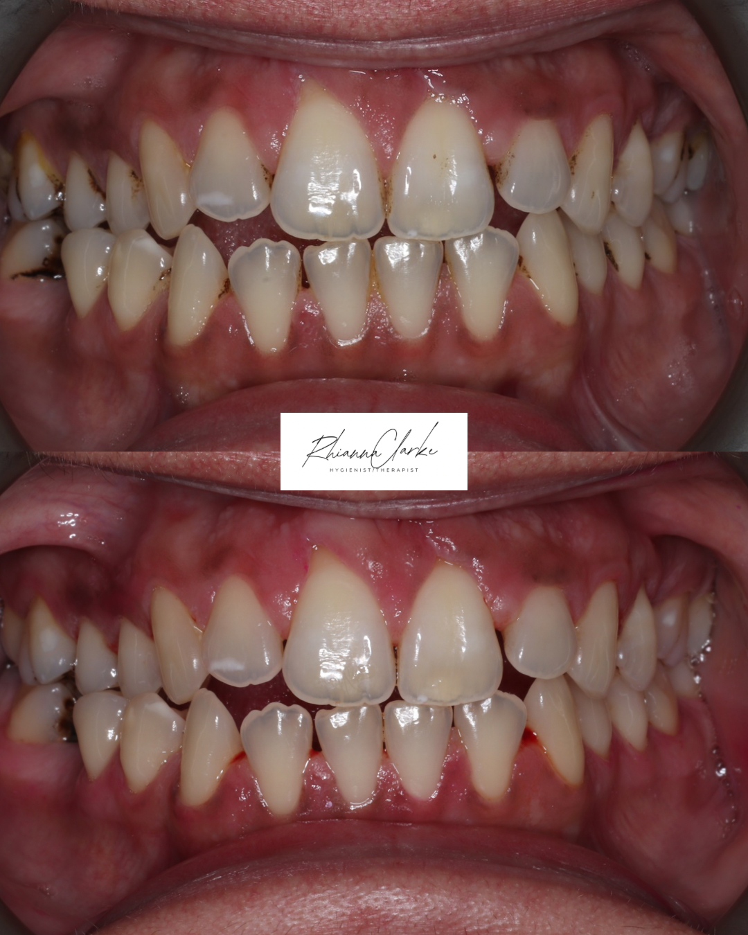 Close-up of teeth showing signs of plaque, tartar buildup, and staining, with some misalignment.