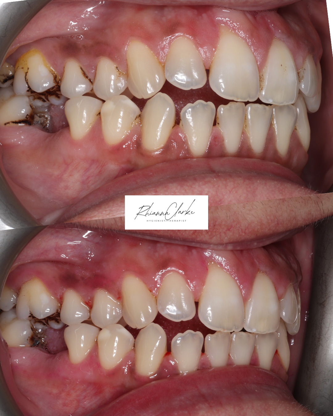 Comparison of teeth before and after dental cleaning and treatment. Top image shows teeth with plaque, tartar, and cavities. Bottom image shows cleaner teeth with reduced plaque and healthier gums.