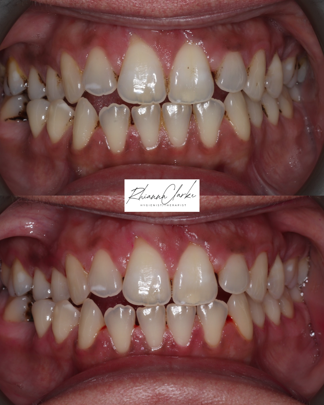 Close-up of a person's teeth before and after dental cleaning showing improvement in gum health and cleanliness.