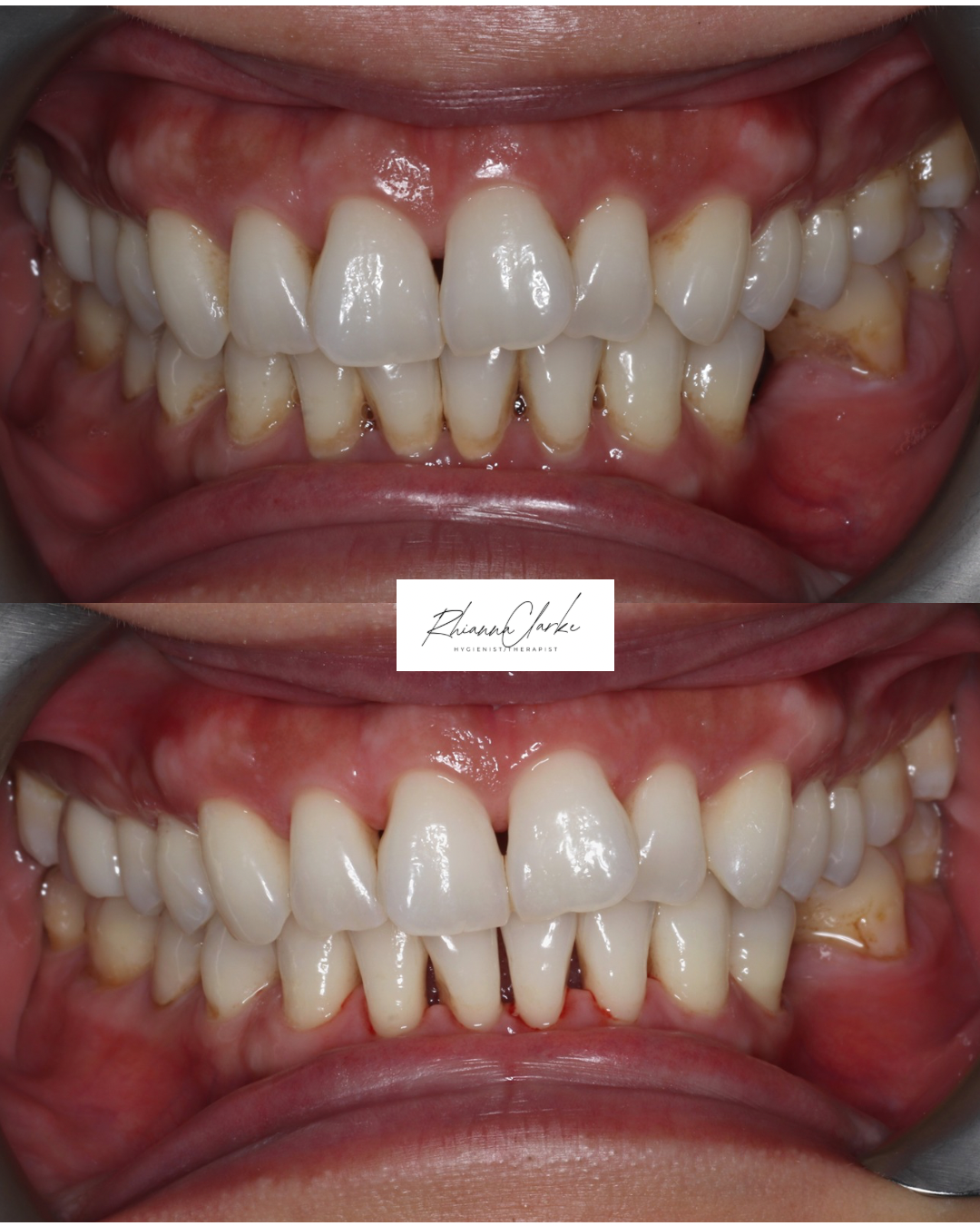 Before and after images of a person's teeth showing improved alignment and cleanliness after dental treatment.