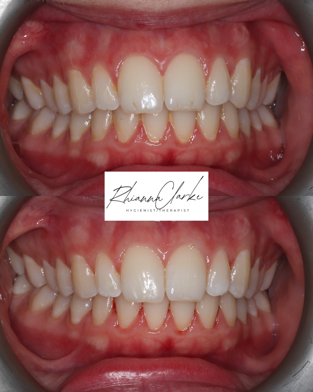Comparison of teeth before and after dental treatment showing improvement in alignment and appearance.