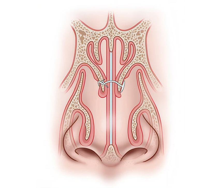 Diagram of a human nose with surgical repair using a stitch or pin in the septum area.