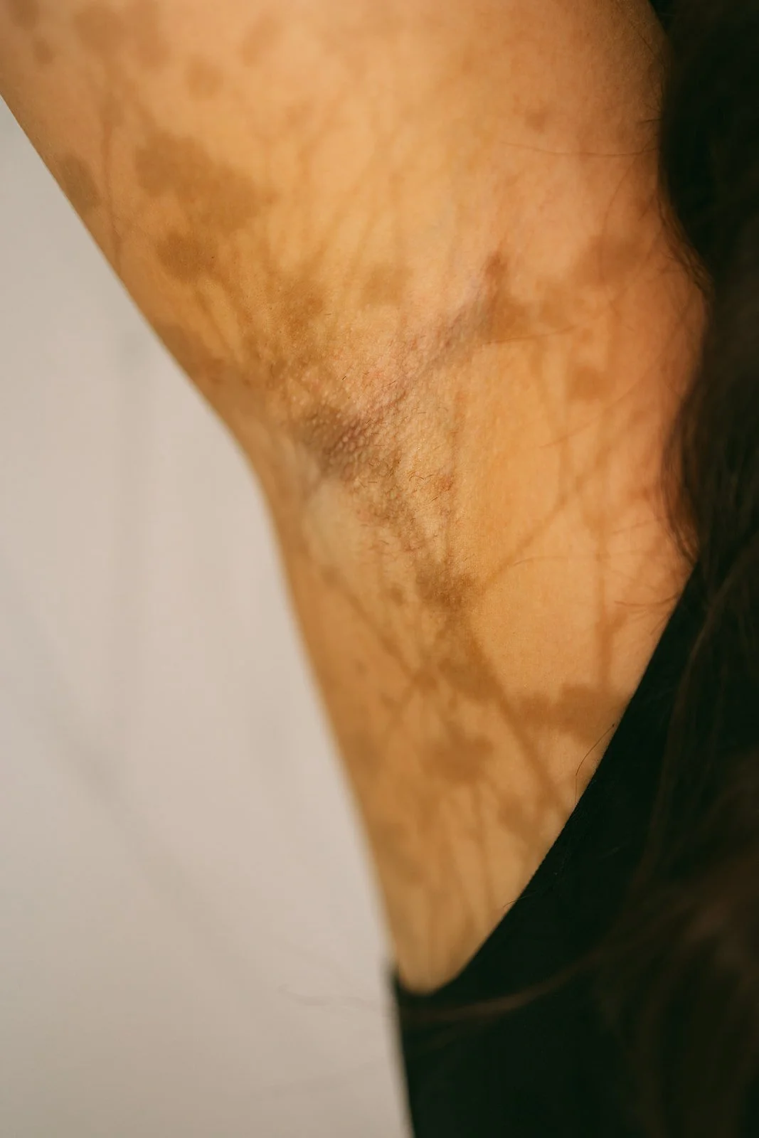 Close-up of a person's armpit with skin discoloration and hyperpigmentation.