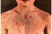 Statement from the Public Health Agency of Canada on Measles