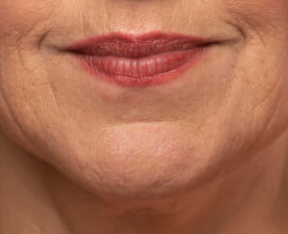 Sonrisa de una persona con labios maquillados y piel envejecida.