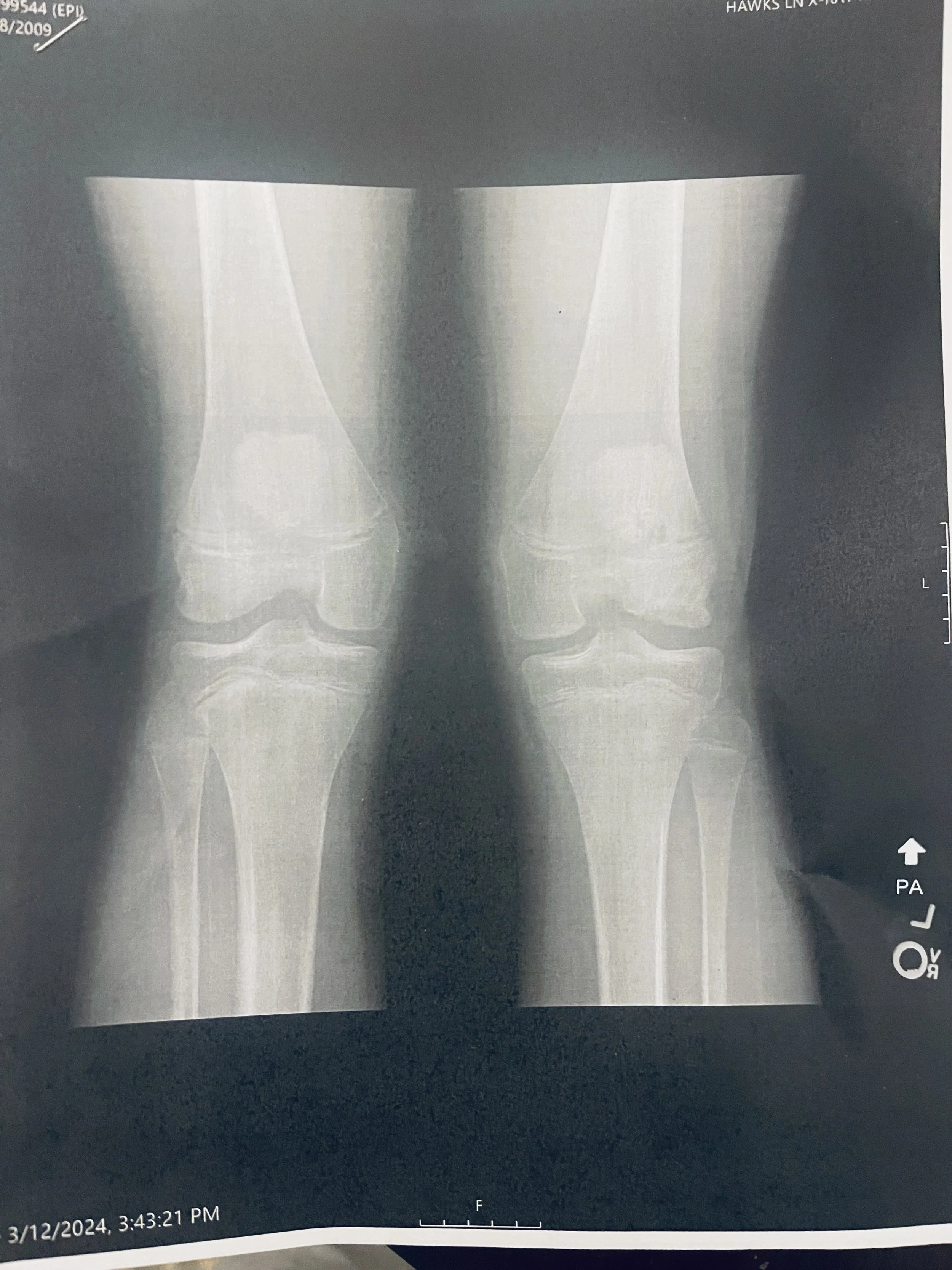 An X-ray image of two human pelvis bones and upper femurs, showing the hip joints. The x-ray appears to be part of a medical examination or evaluation.