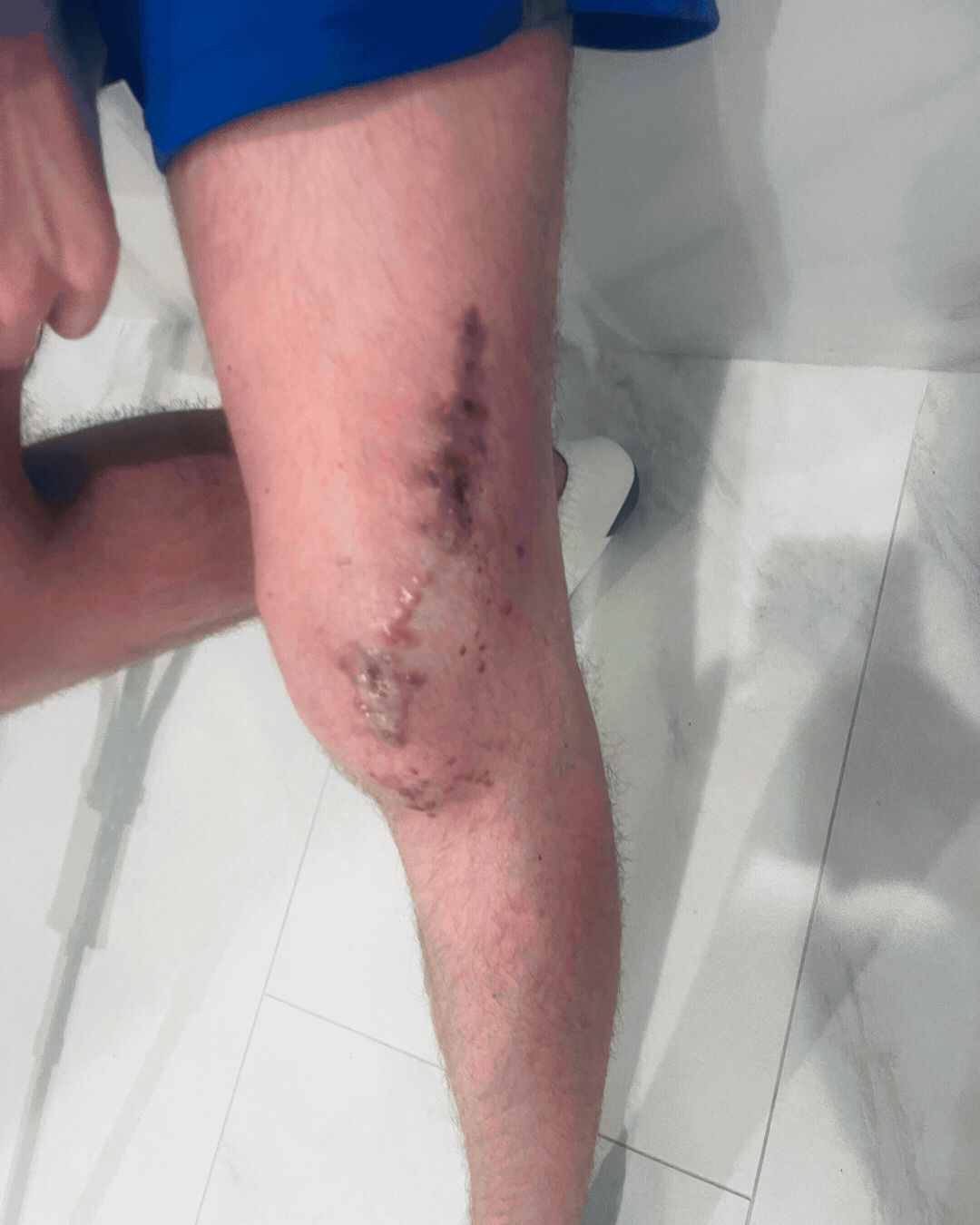 Close-up of a person's leg with a large, healing surgical scar and stitches.
