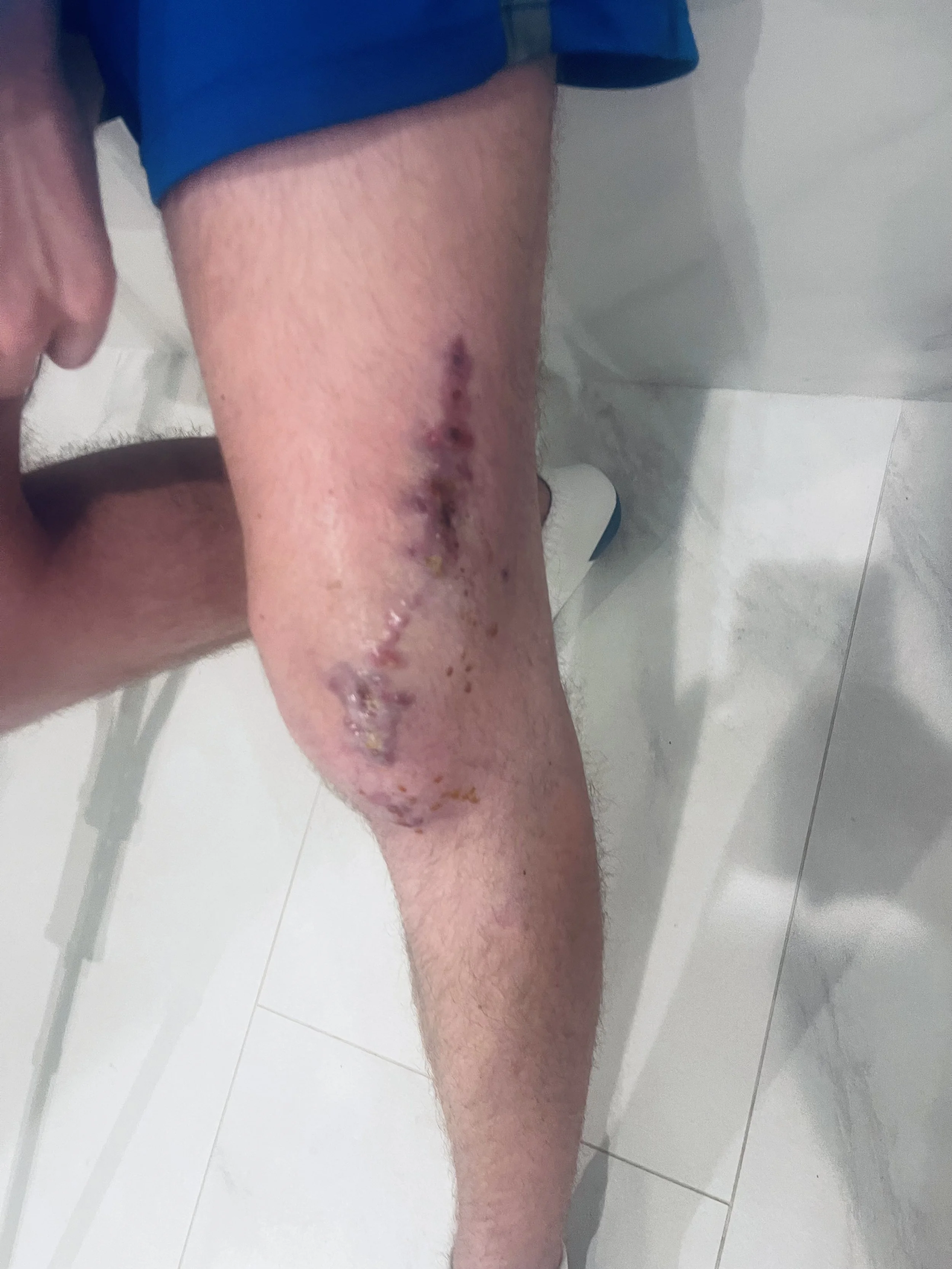 A person's leg with a visible scratch or wound that appears to be healing, with some scabbing and redness.