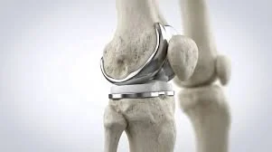 Close-up of a ceramic hip joint model with a person in the background.