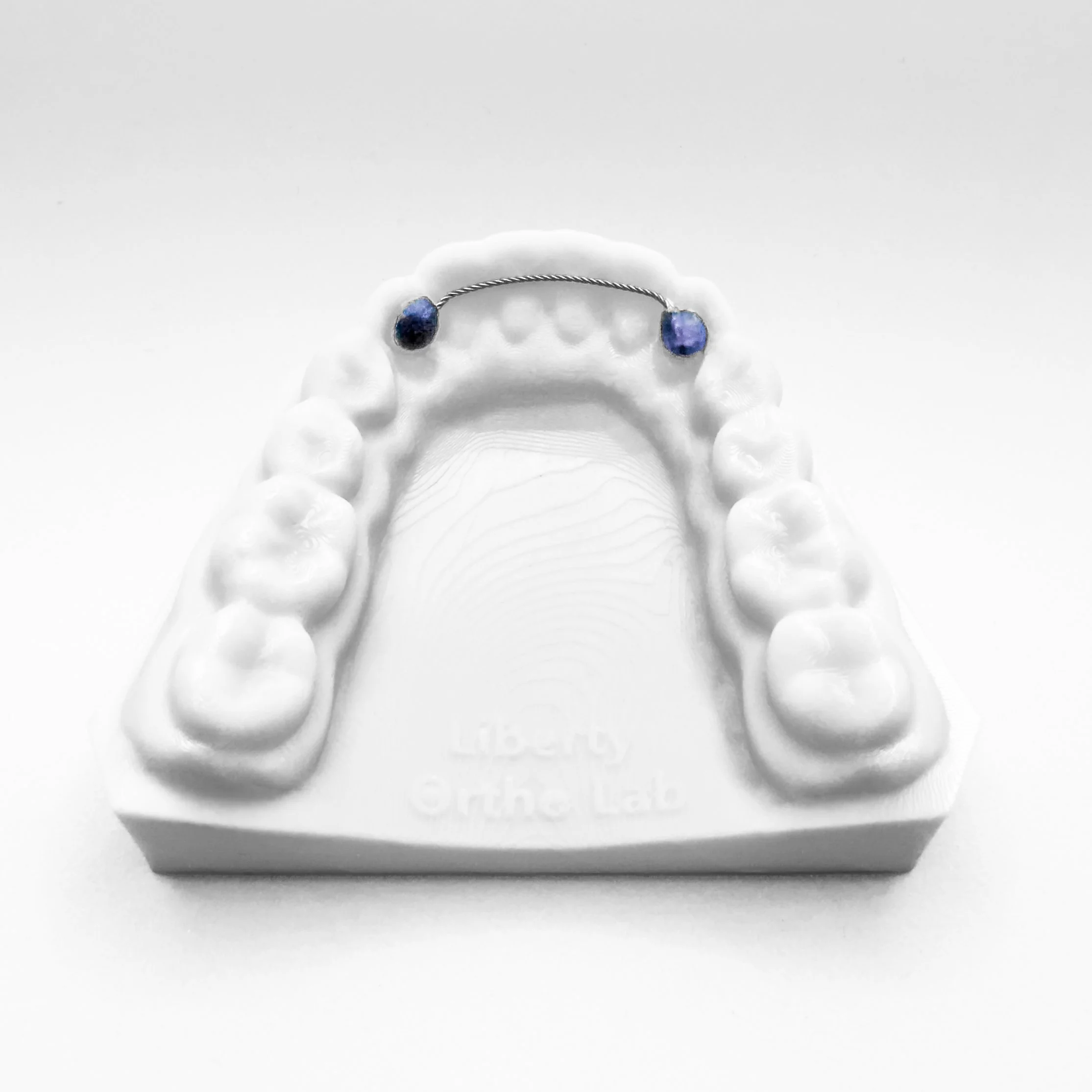 Bonded Lingual Retainer