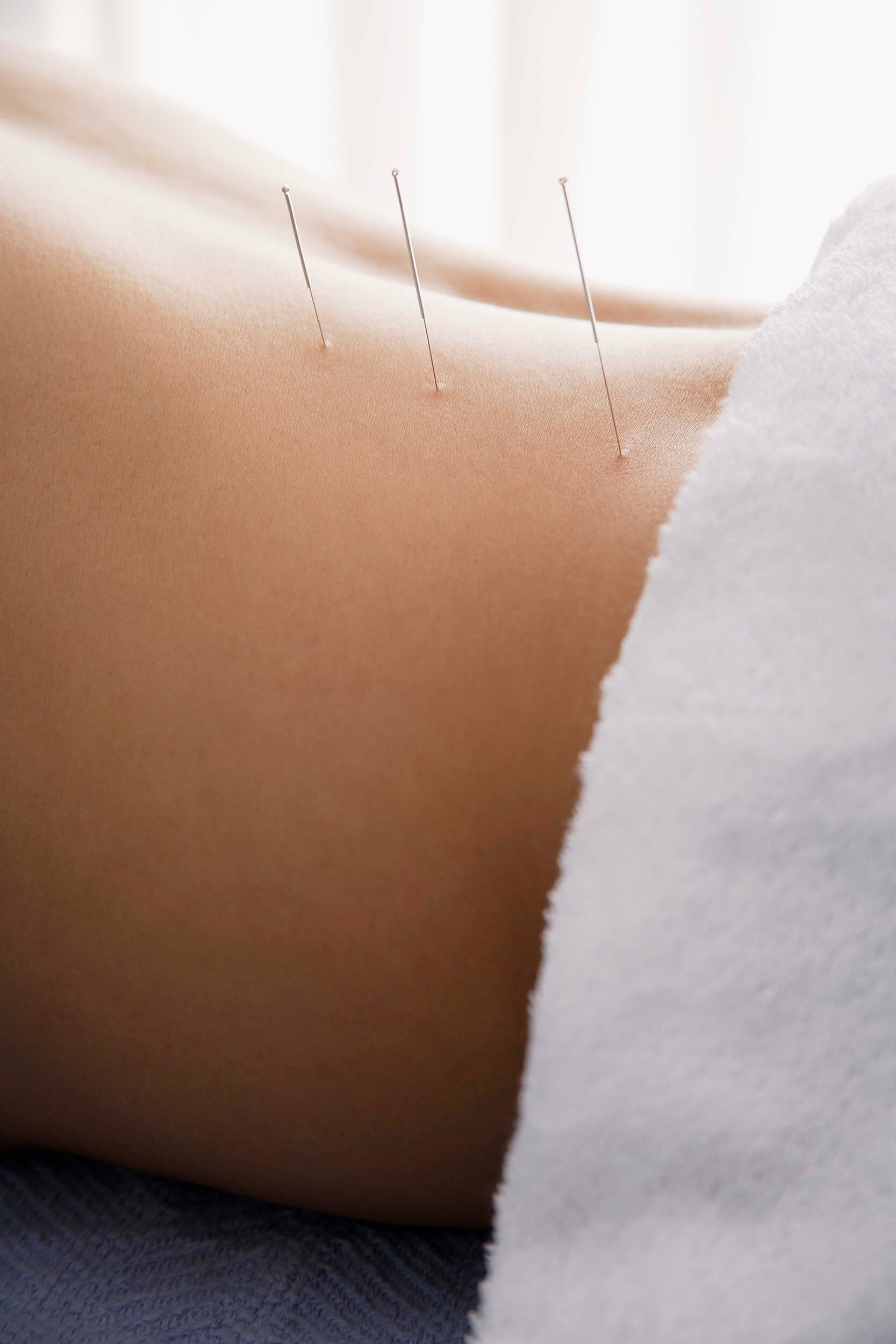 Close-up of a person receiving acupuncture for women's fertility at New Heights Acupuncture and Chinese Medicine in Houston, Texas.