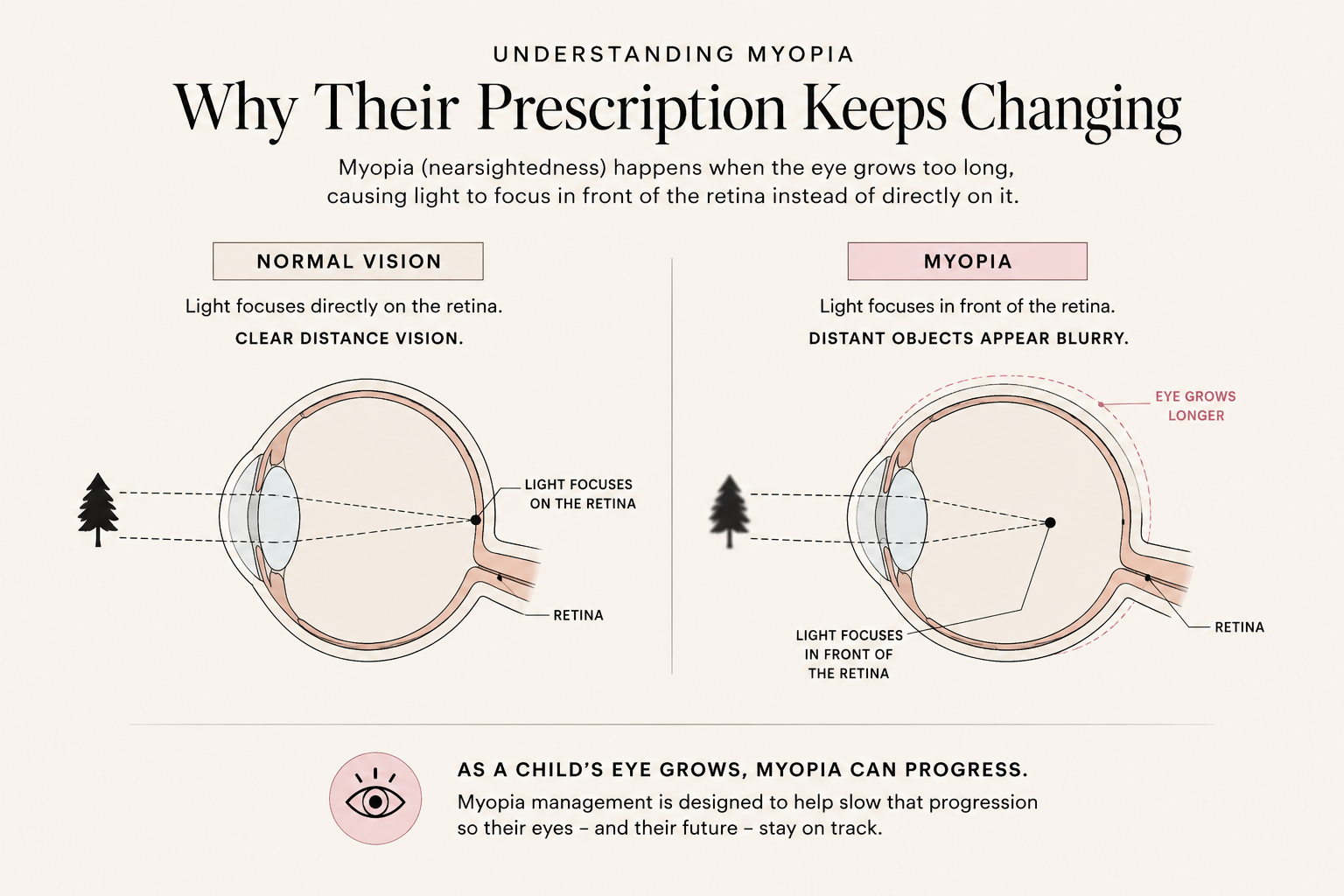 Diagram comparing normal vision and myopia in the eye, showing how light focuses on the retina in normal vision and in front of the retina in myopia, leading to blurry distant objects.