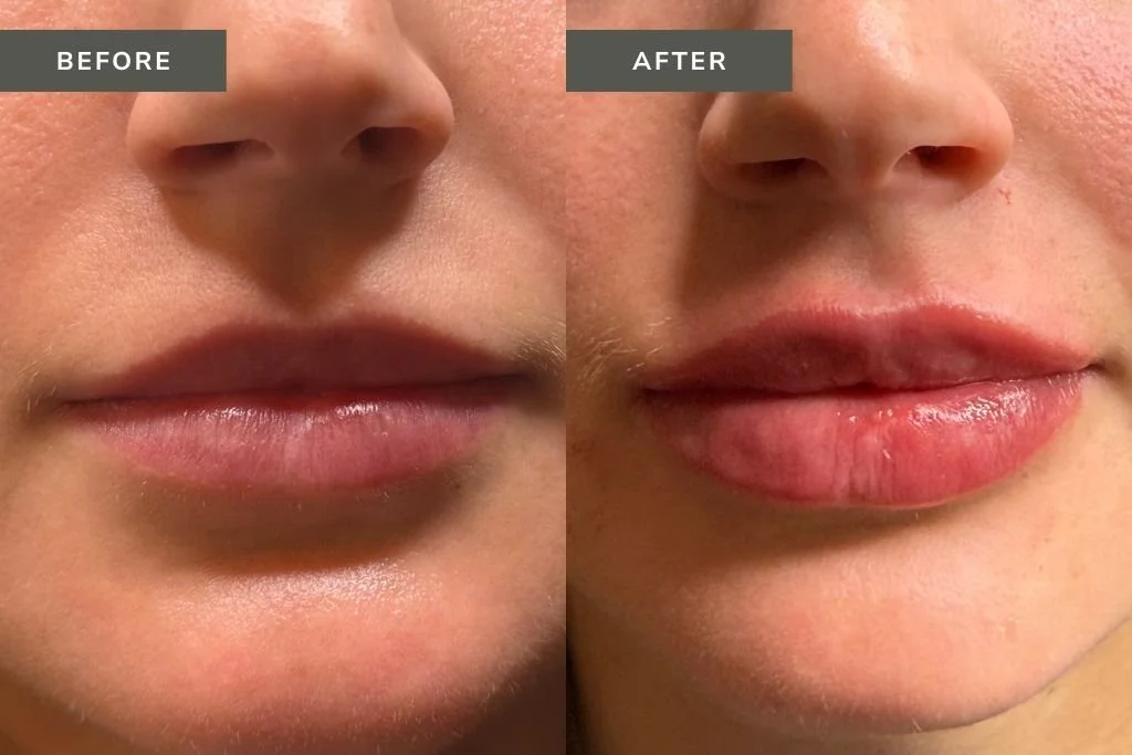 Lip Filler Before and After Results