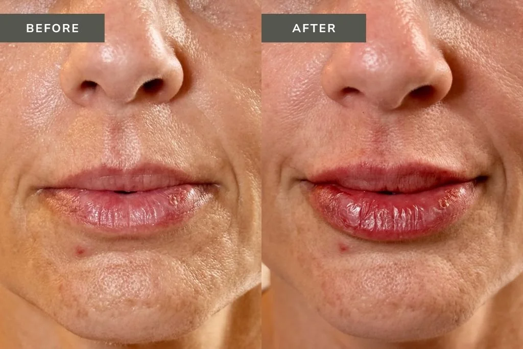 Lip Filler Before and After Results
