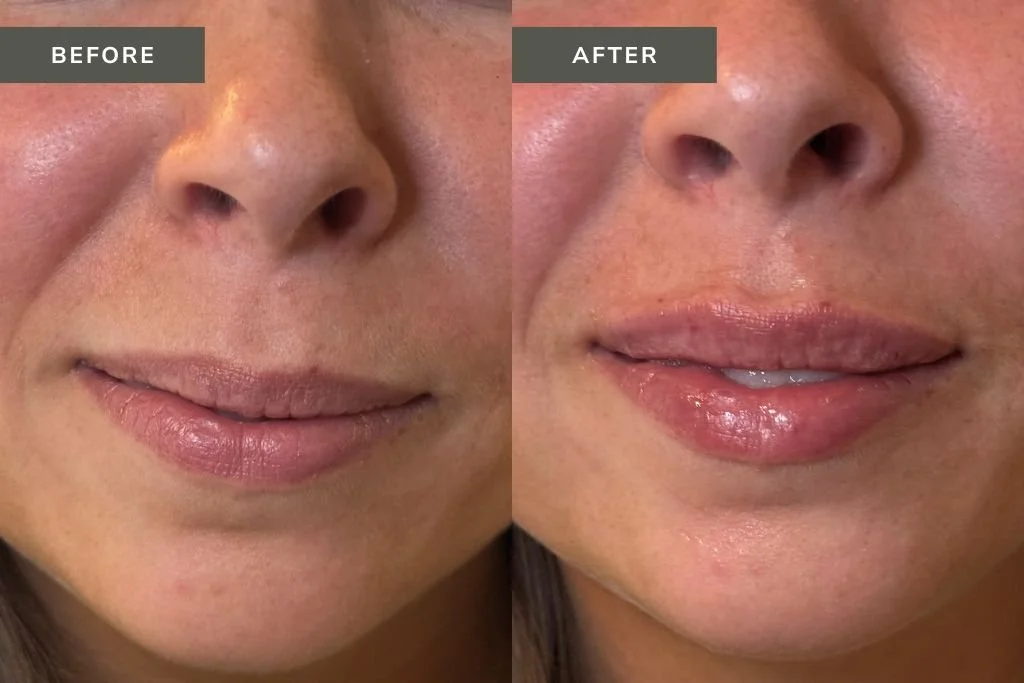 Lip Filler Before and After Results