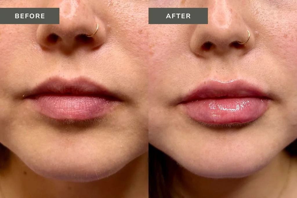Lip Filler Before and After Results