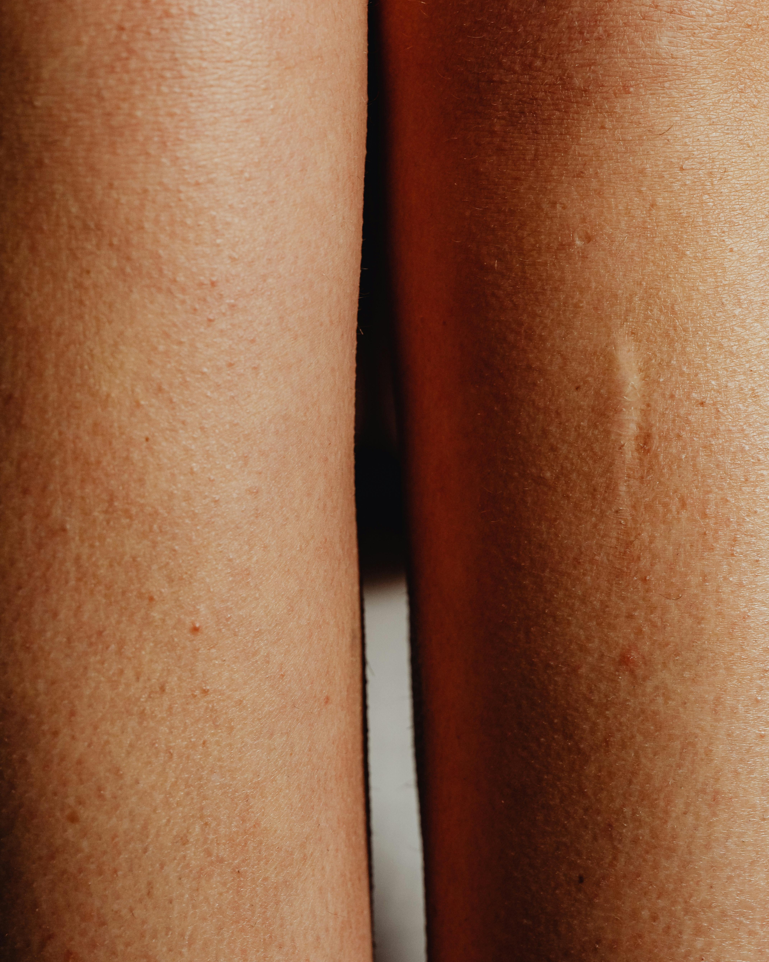 New Skin Peel