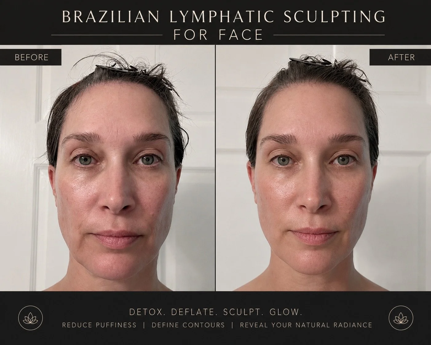 Before and after photos illustrating Brazilian lymphatic sculpting for the face, showing reduced puffiness, more defined contours, and natural radiance.