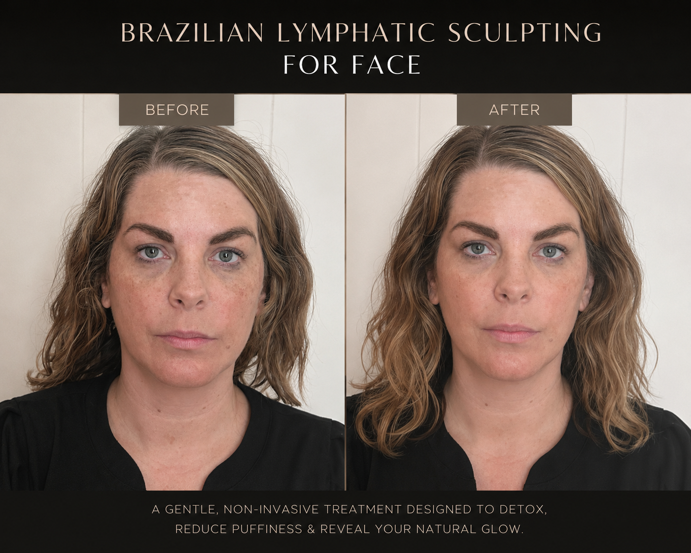 Side-by-side comparison of a woman before and after facial treatment. The left side shows her face with freckles and uneven skin tone, labeled 'Before.' The right side shows her face with a smoother complexion, labeled 'After.' The sign above indicates the treatment is Brazilian Lymphatic Sculpting for face.