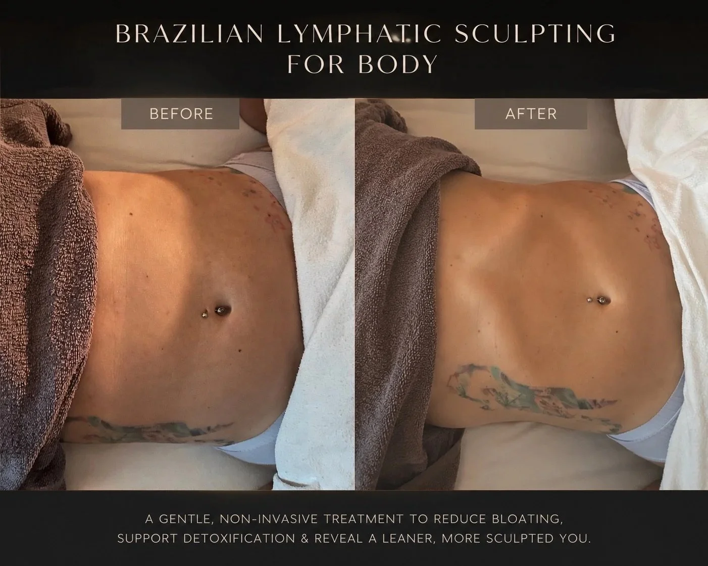 Comparison of a person's abdomen before and after Brazilian lymphatic sculpting treatment, showing reduced bloating and a more toned appearance.