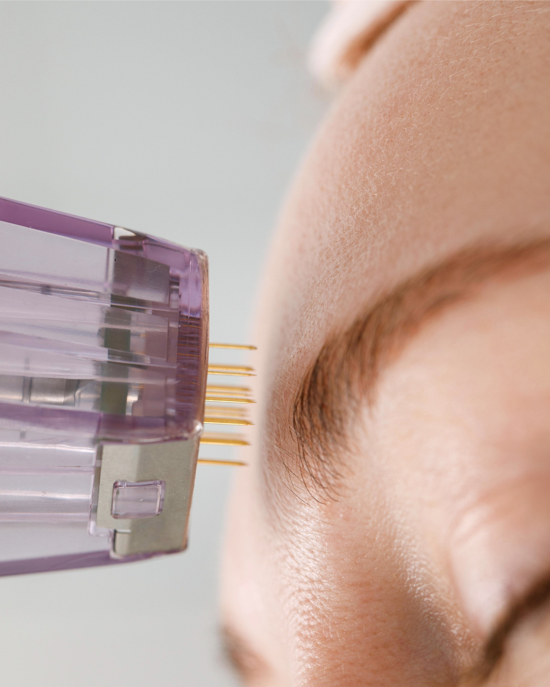 Close-up of a forehead and a Morpheus8 RF Microneedling tip with multiple tiny needles near the skin.