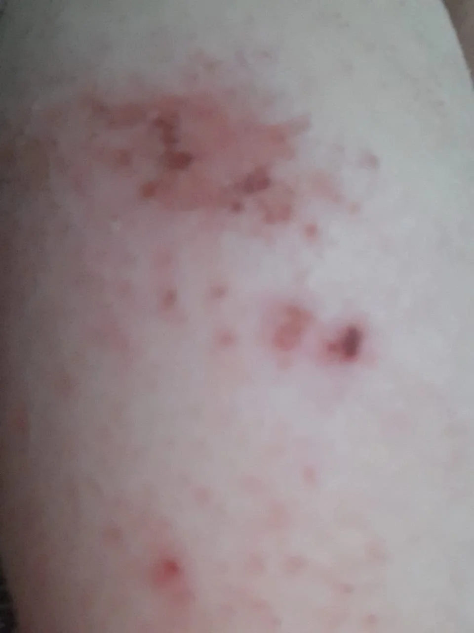 Close-up of a skin rash with red, irritated spots.