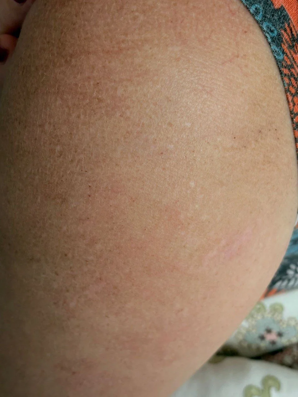 Close-up of a person's skin showing slight redness and dryness.