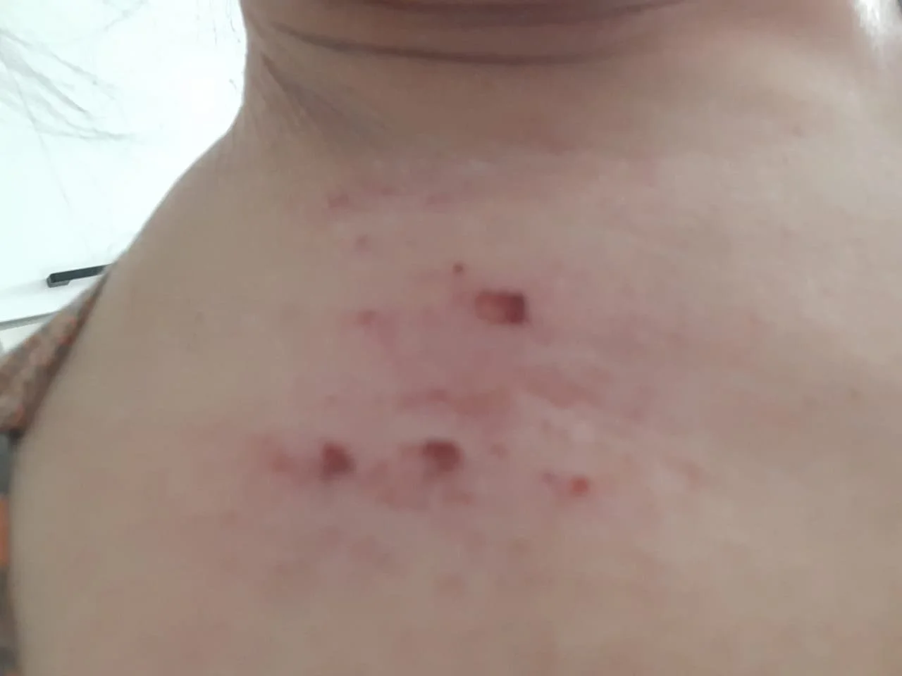Close-up of a person's neck with multiple red and inflamed pimples or acne scars.