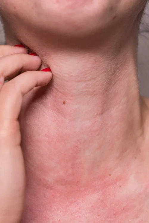 Close-up of a person's neck with visible redness and a small mole, with fingers touching the side of the neck.