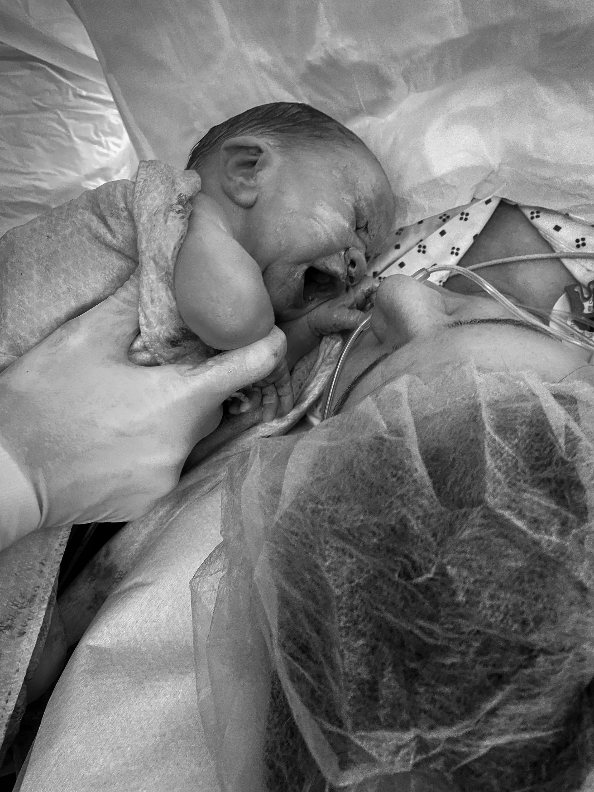 A baby crying after C-section with mother