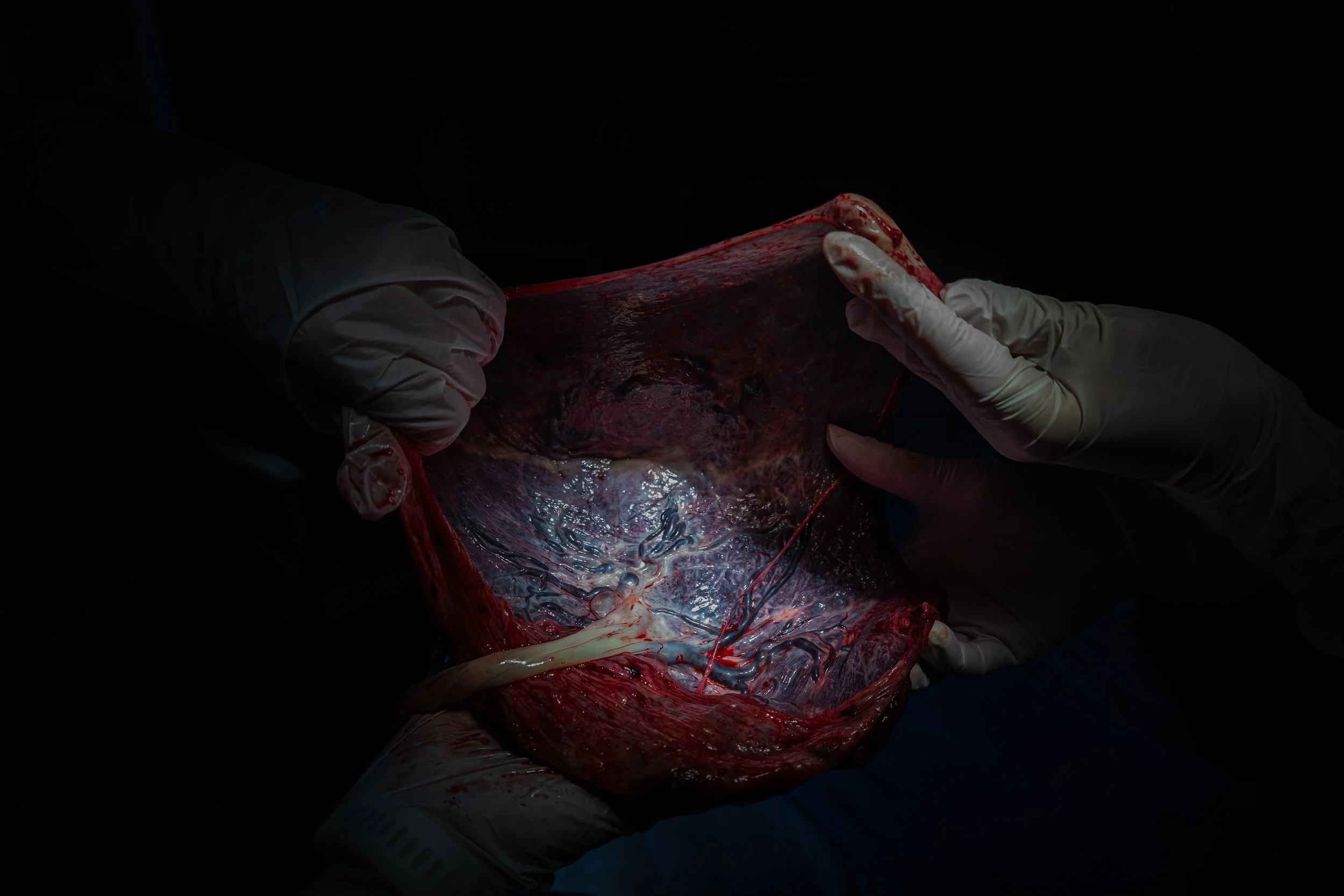 Close-up view of biological tissue/placenta with dark and red areas, depicting internal organs after birth