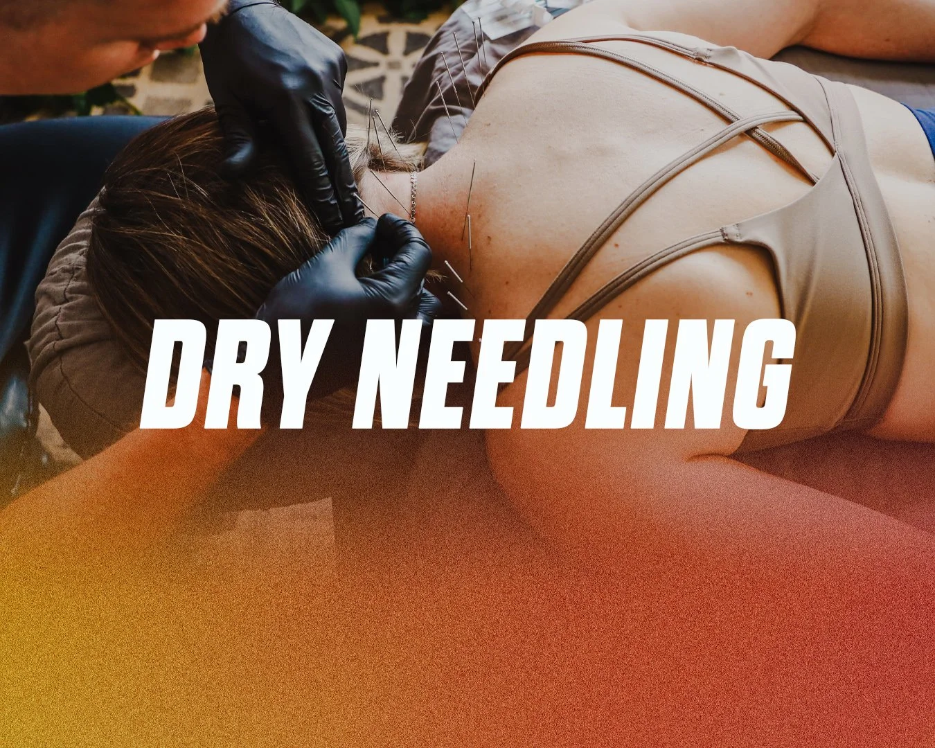Person receiving dry needling treatment on their back from a practitioner wearing black gloves.