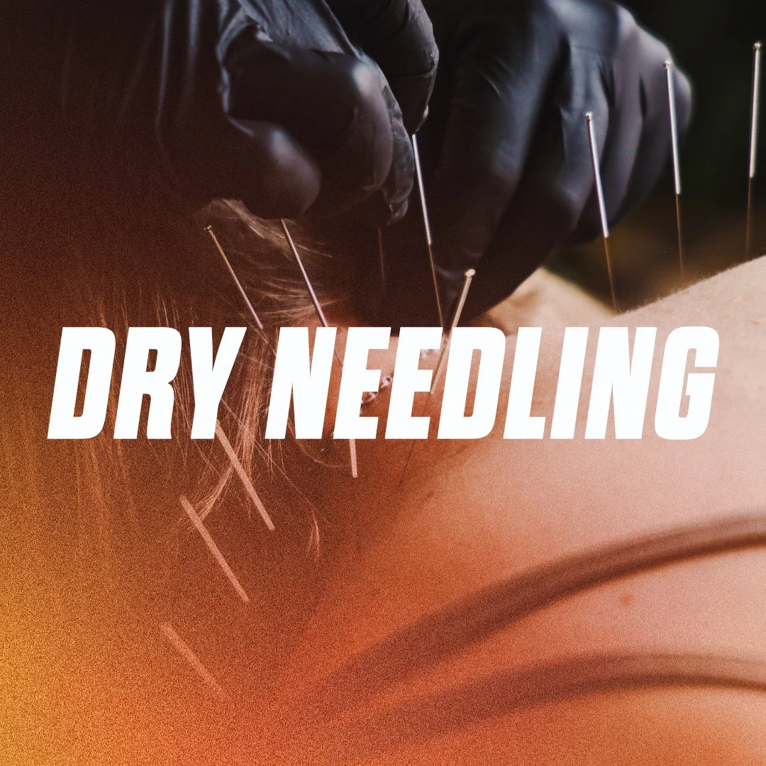A person receiving dry needling therapy with thin needles inserted into their skin.