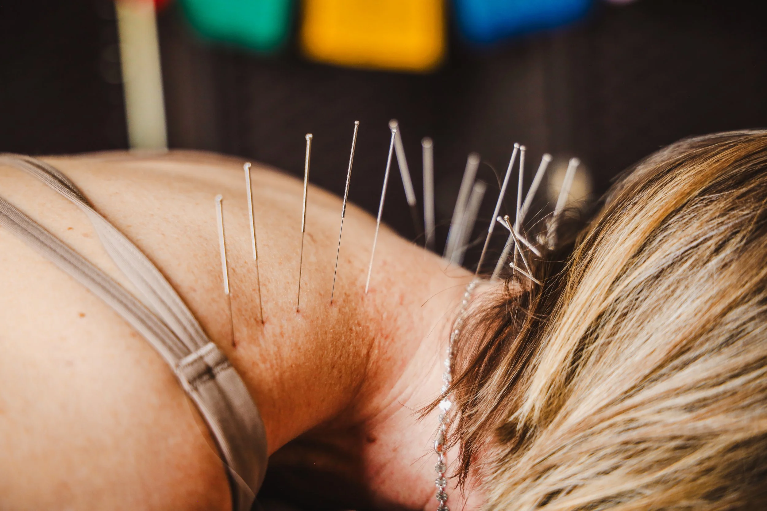 Close-up of a person receiving acupuncture, with multiple acupuncture needles inserted into their back.
