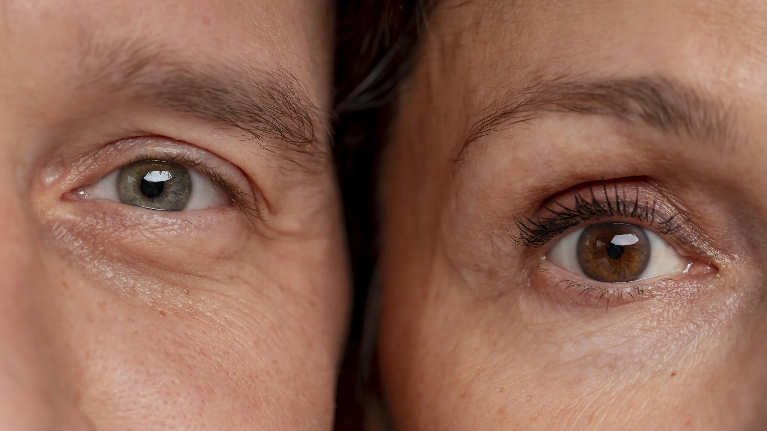 Eye Puffiness vs Dark Circles: What’s the Difference?