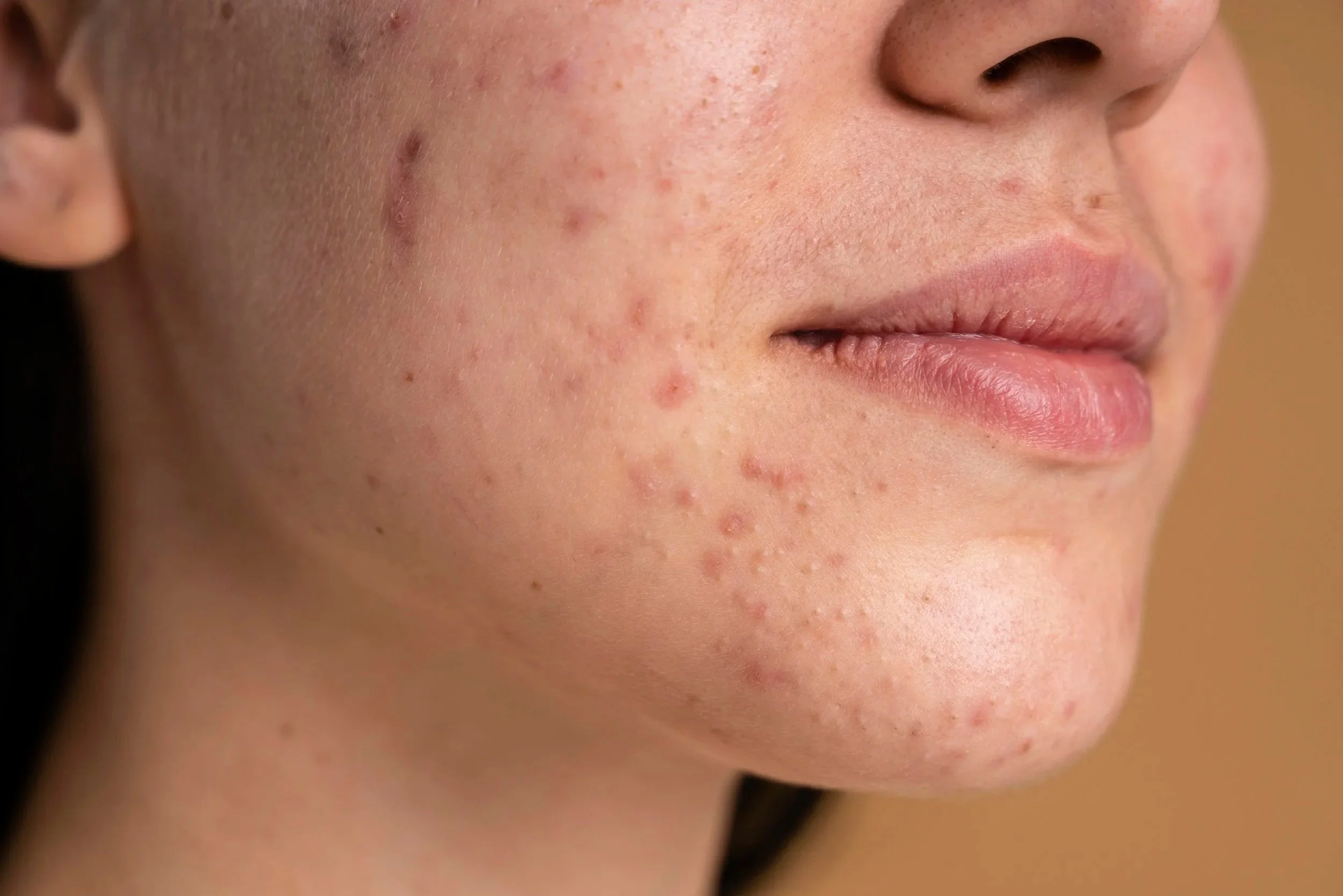 Adapalene for Acne and Aging: The Over the Counter Retinoid Guide