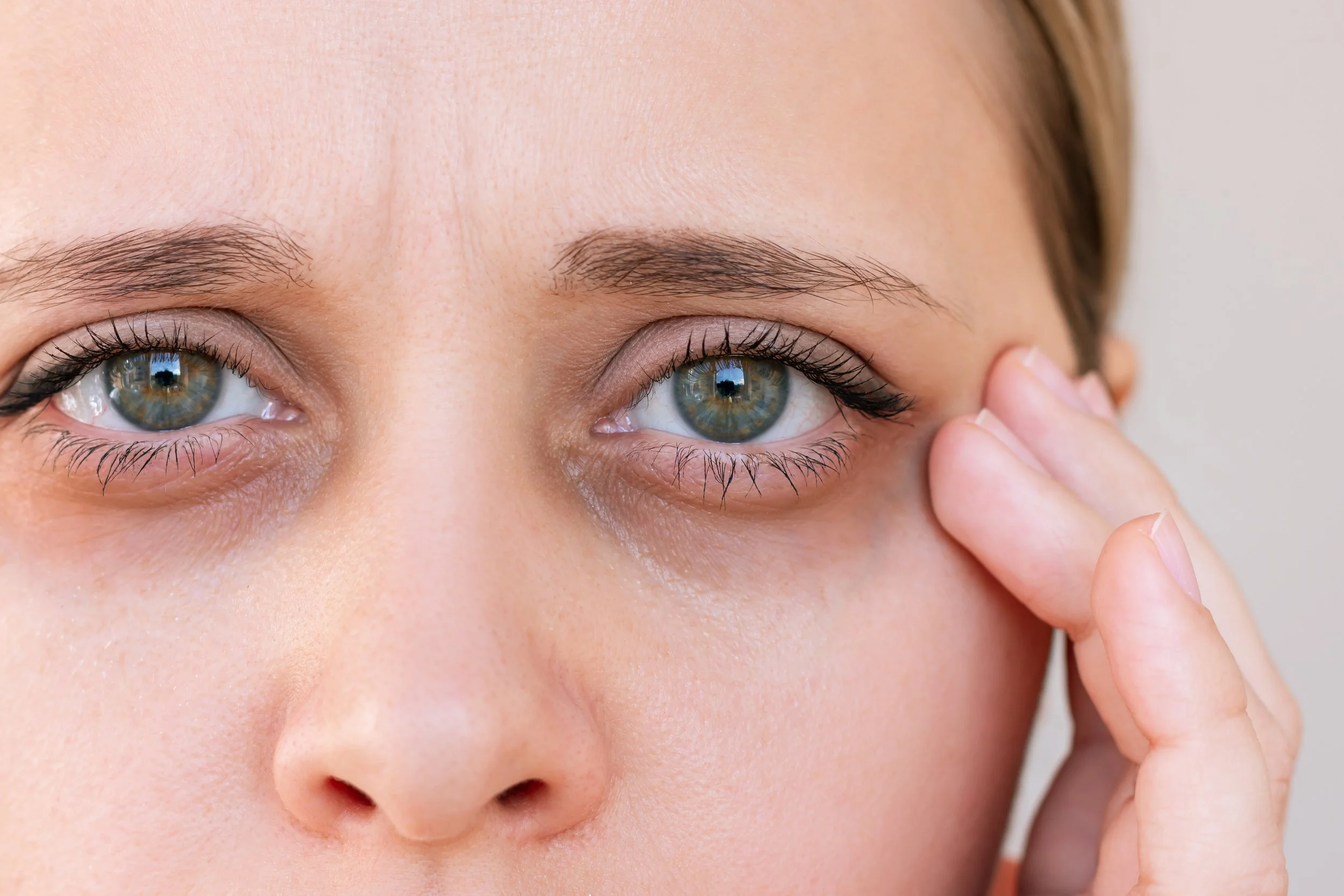 Puffiness Around the Eyes: Cosmetic Causes and What to Look For in Eye Care