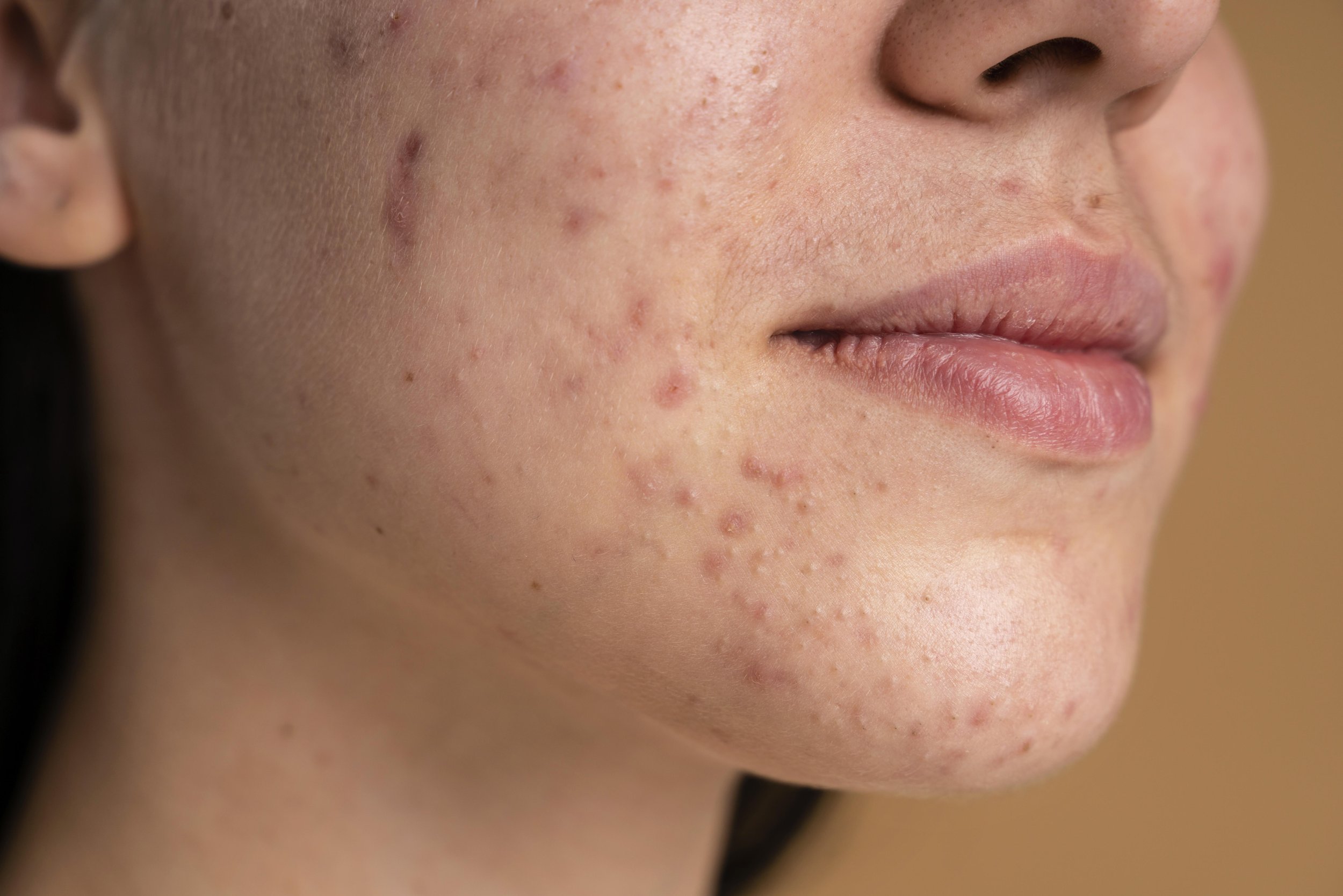 Acne-Prone and Sensitive Skin: How to Choose the Best Professional Skincare Products