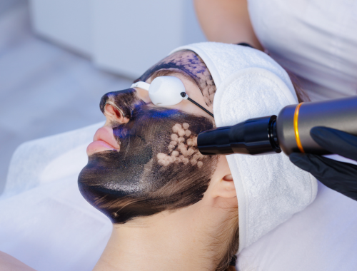A woman receiving a facial treatment with a black facial mask applied, while a technician uses a black handheld device on her skin.