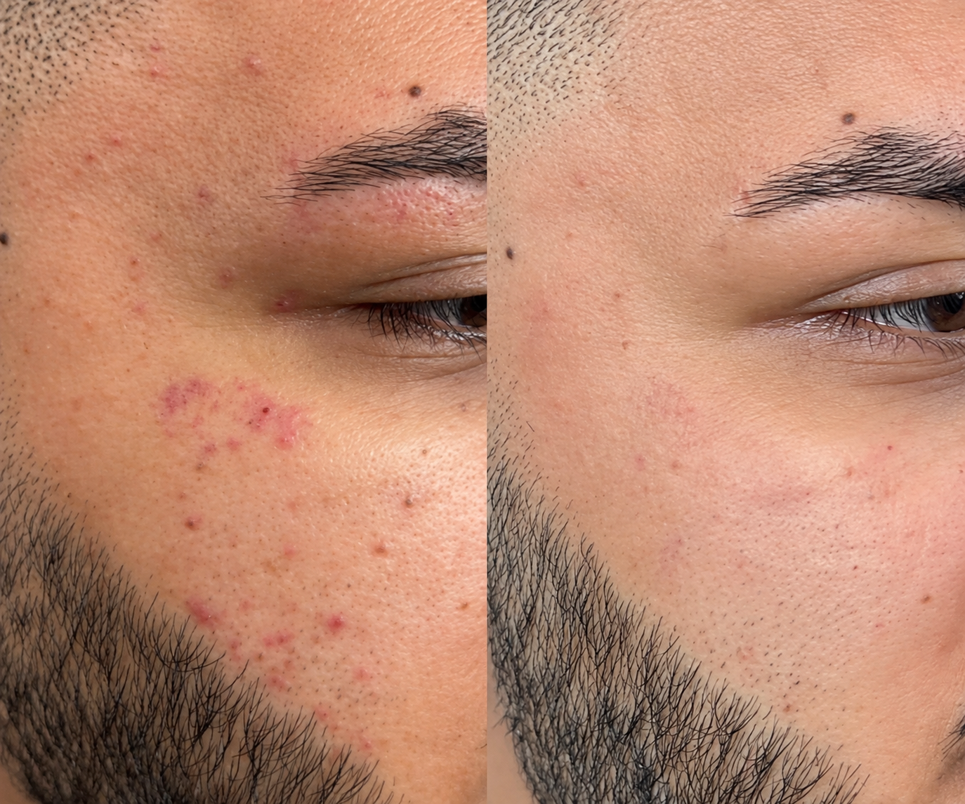 Microdermabrasion Facial 6
