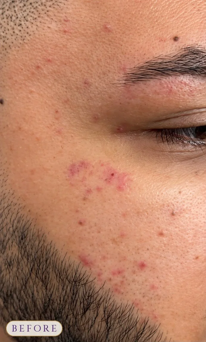 Microdermabrasion_MAN_Before.jpg