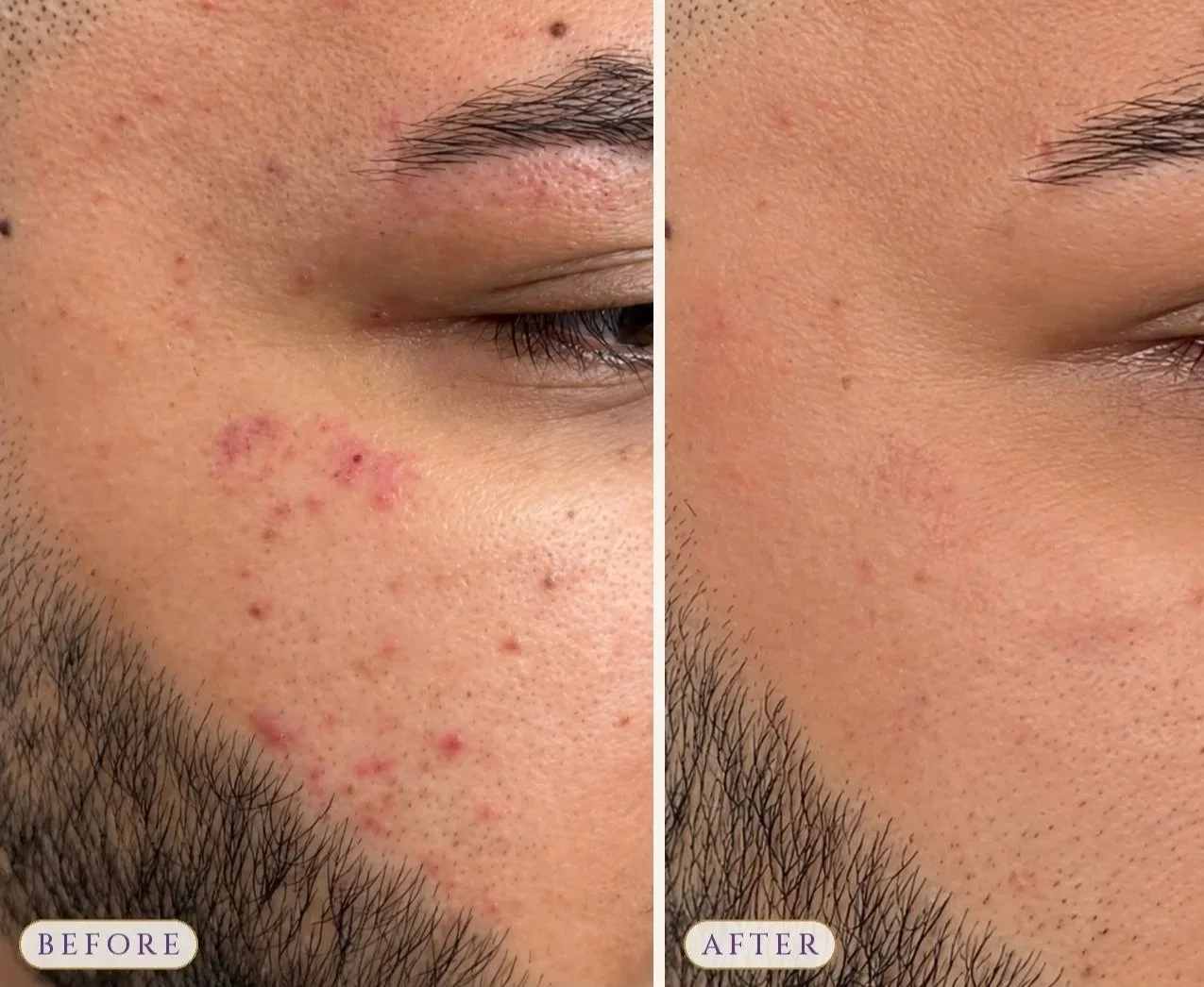 Microdermabrasion Single Treatment