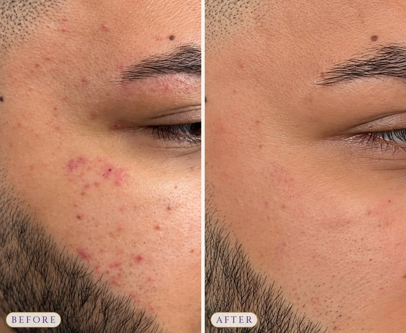 Microdermabrasion Facial x 3