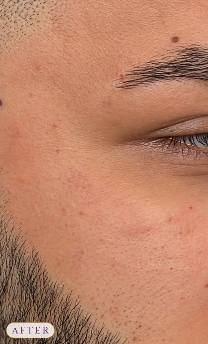 Microdermabrasion_MAN After.jpg