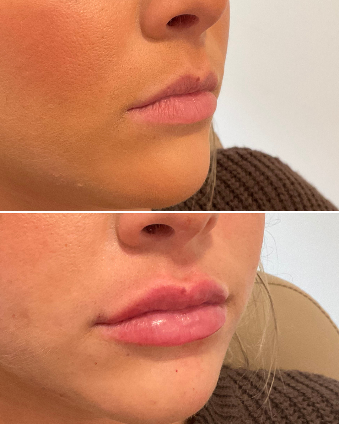 LIP FILLER
