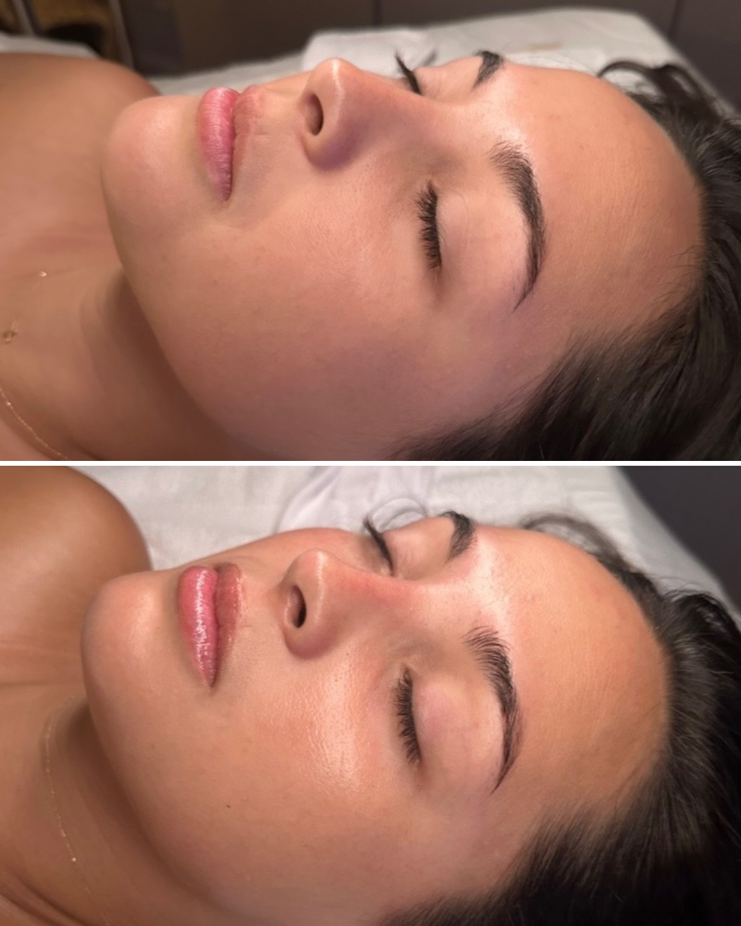 HYDRAFACIAL