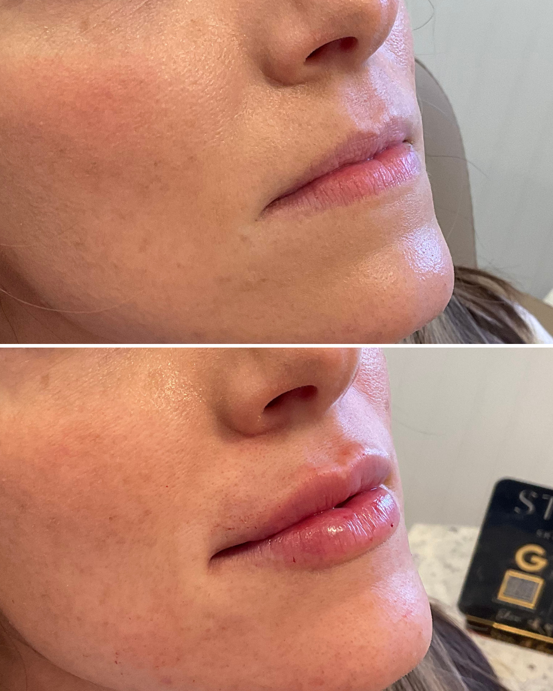 LIP FILLER